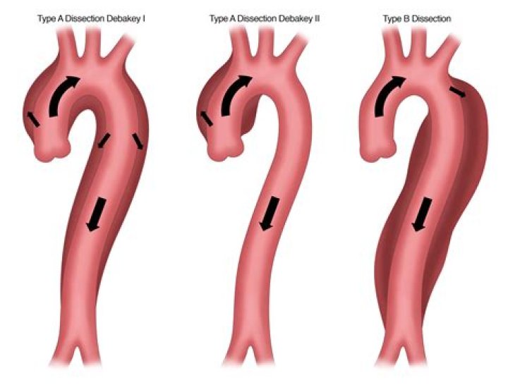 Are aortic dissection hereditary?