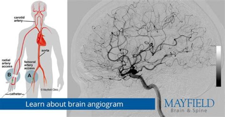 Are cerebral angiograms safe?