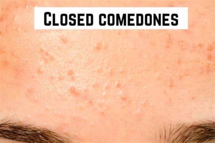 Are closed comedones whiteheads?