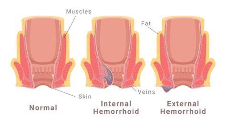 Are external hemorrhoid painful?