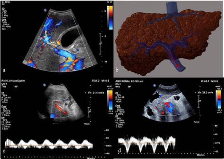 Are hepatic veins hepatofugal?