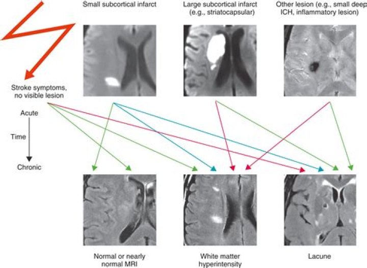 Are lacunar infarcts embolic?