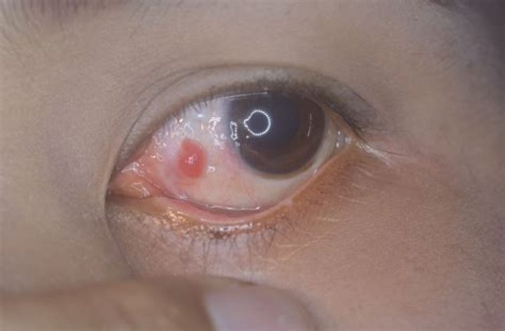 Are pyogenic granuloma common?
