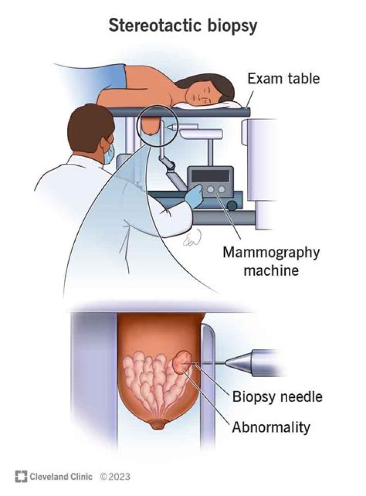 Are stereotactic breast biopsies painful?