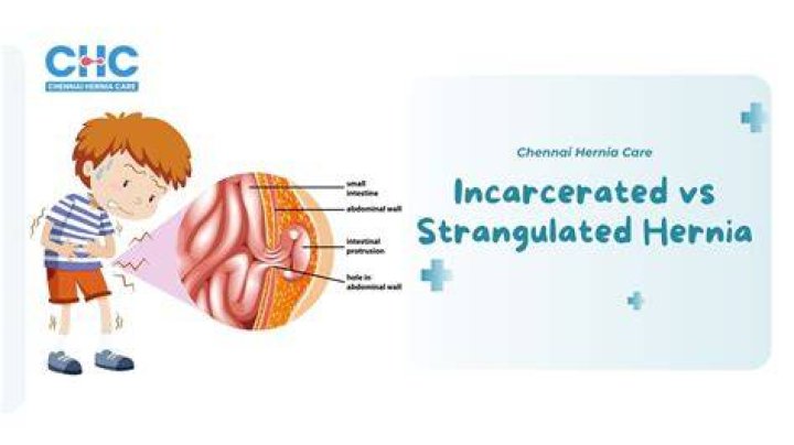 Are strangulated hernias common?