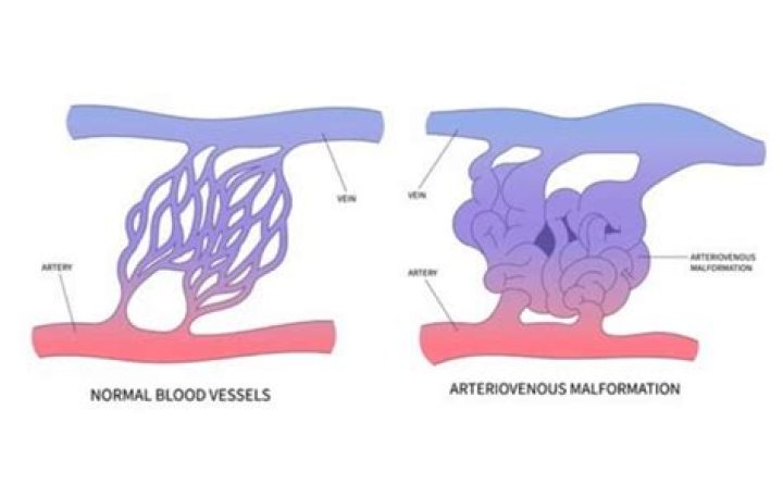 Are vascular malformations dangerous?
