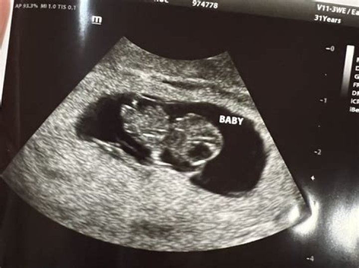 Can abnormalities be detected at 8 week scan?
