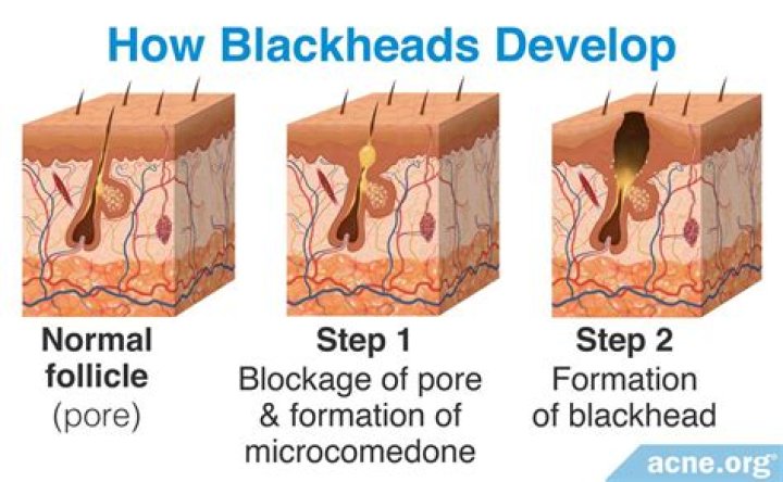 Can blackheads kill you?