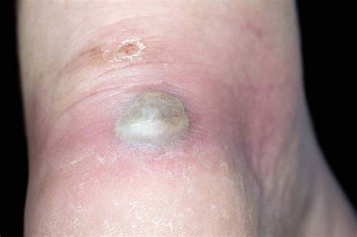Can blisters get infected?