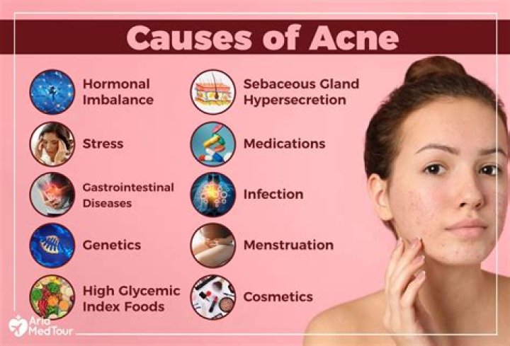 Can curd cause acne?