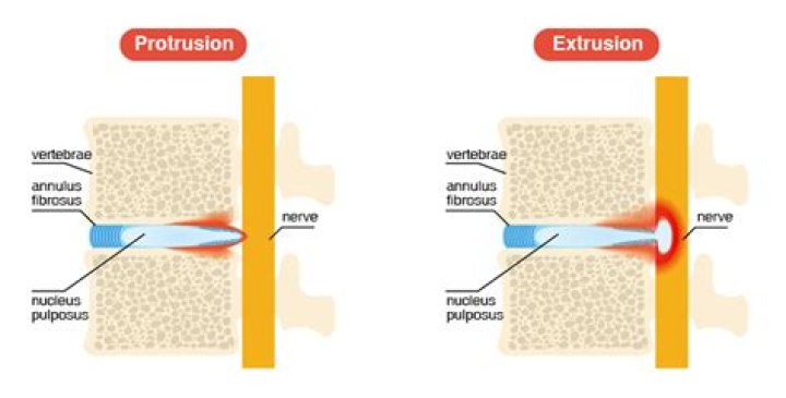 Can disc extrusion heal?