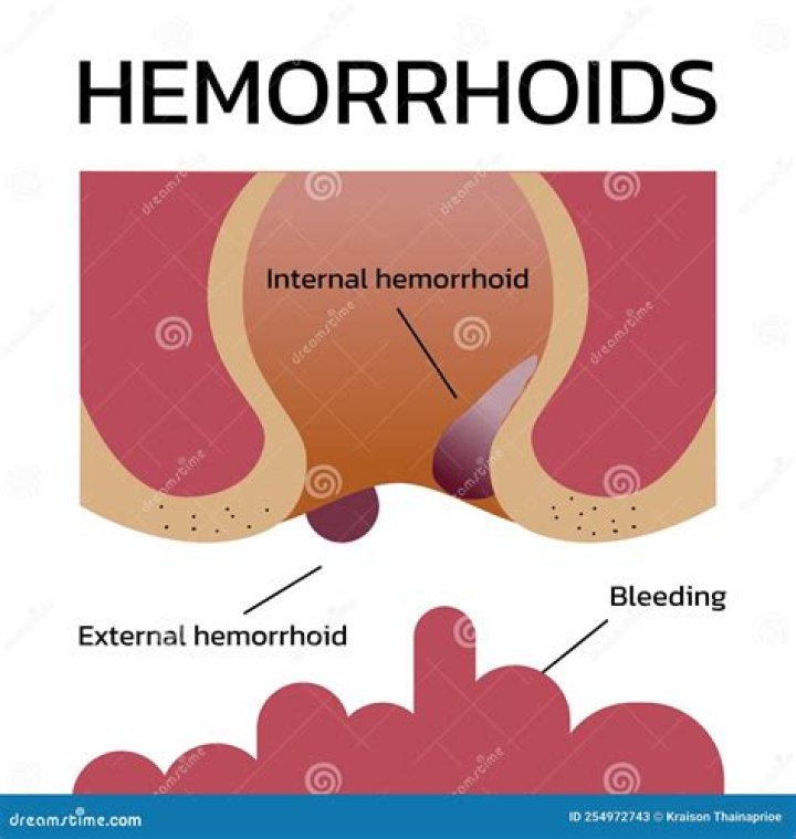 Can external hemorrhoids be ligated?