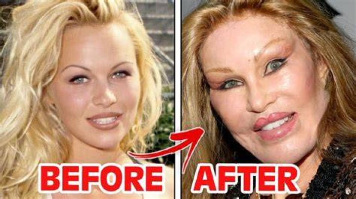 Can facelifts gone wrong?