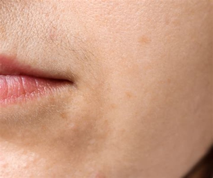 Can hirsutism go away?