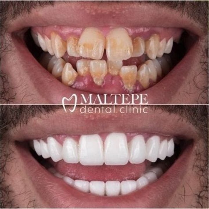 Can i get my teeth evened out?
