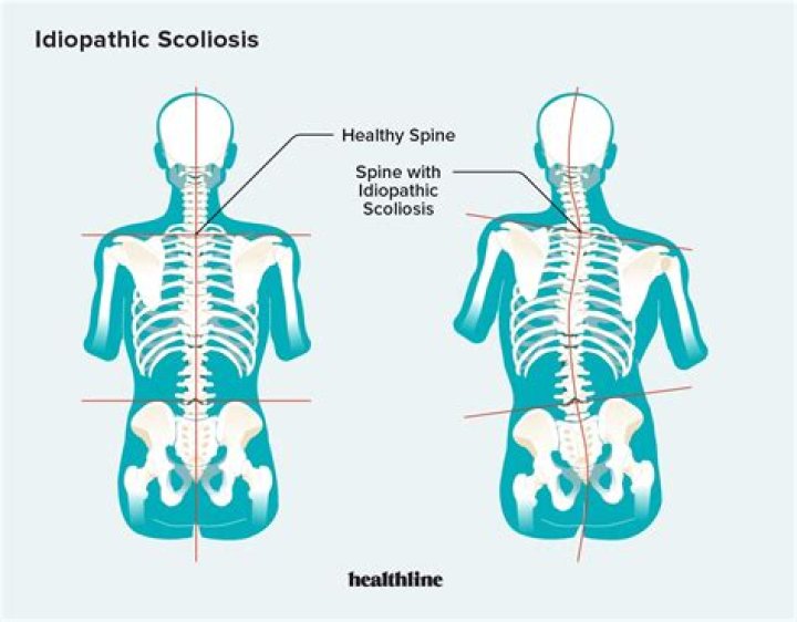 Can idiopathic scoliosis correct itself?
