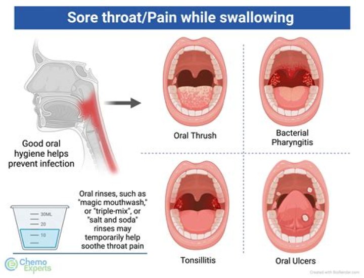Can mouthwash cause sore throat?