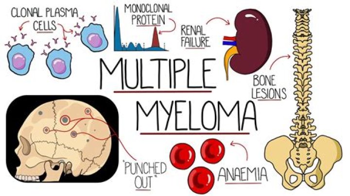 Can myeloma affect the brain?