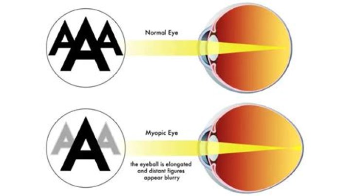 Can myopia develop presbyopia?