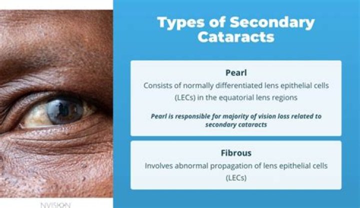 Can secondary cataracts come back?
