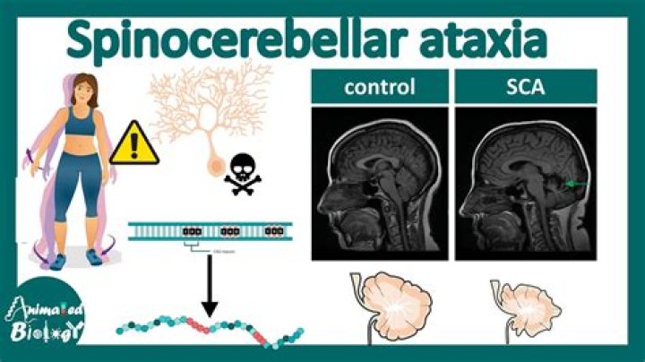 Can spinocerebellar ataxia be cured?