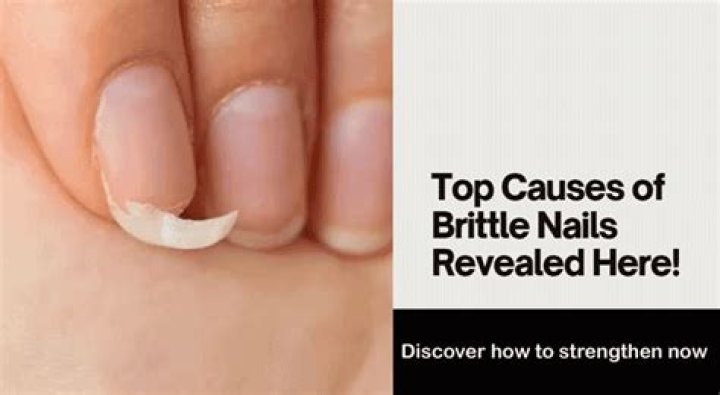 Can stress cause brittle nails?