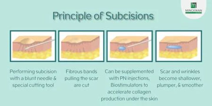 Can subcision cause scarring?