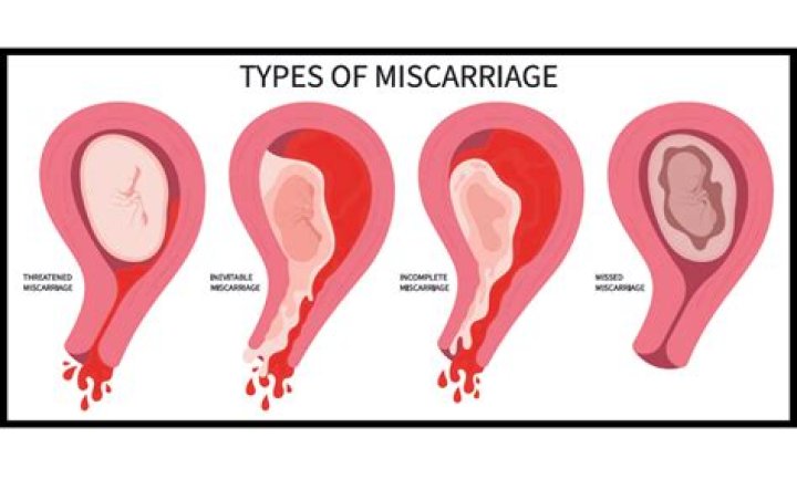 Can sudden movements cause miscarriage?