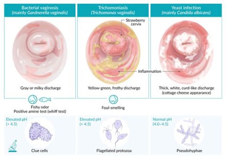 Can trichomoniasis go away?