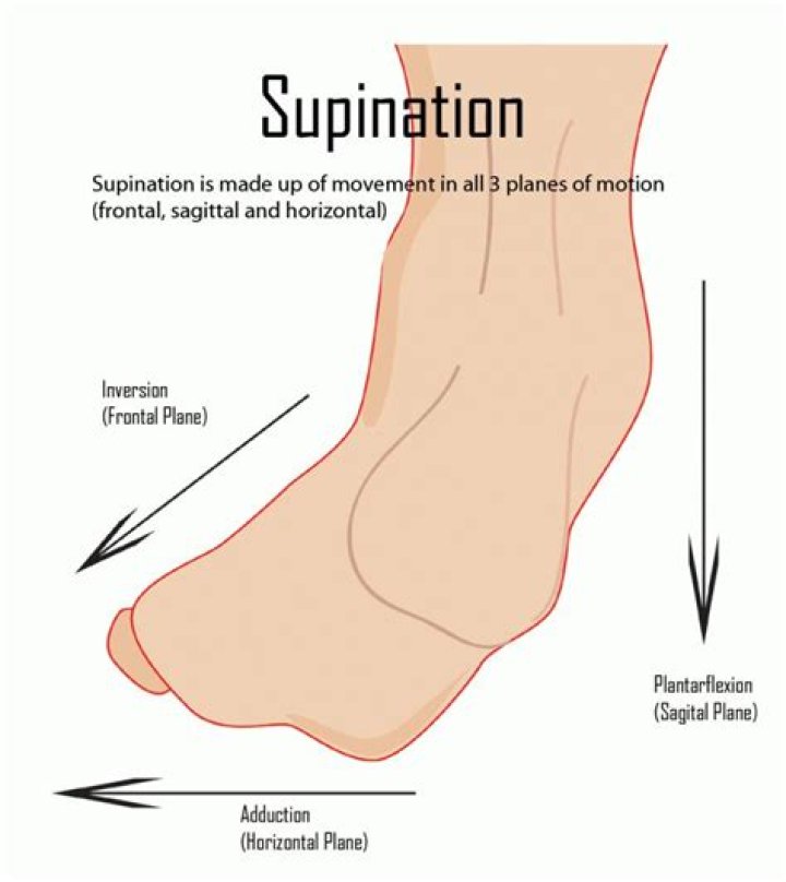 Can you cure supination?