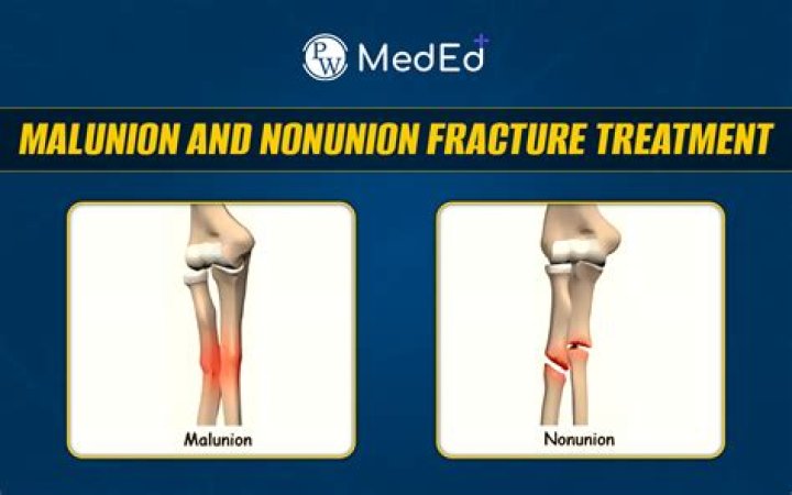 Can you fix a malunion?