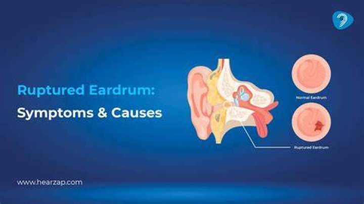 Can you fly with a ruptured eardrum?