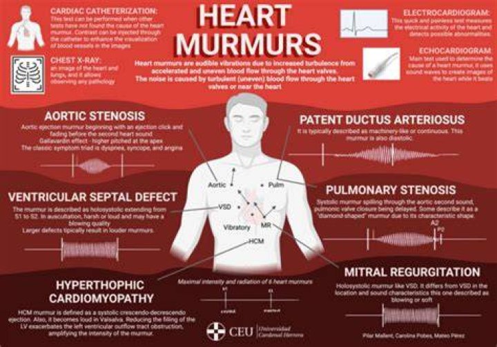 Can you get rid of heart murmur?