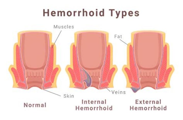 Did my hemorrhoid pop?
