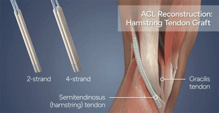 Do acls repair themselves?