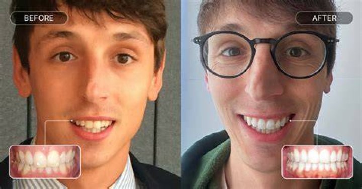 Do aligners help with overbite?