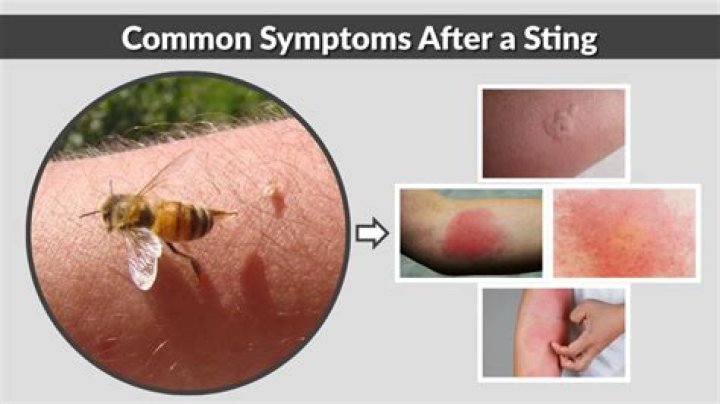 Do bee stings really hurt?