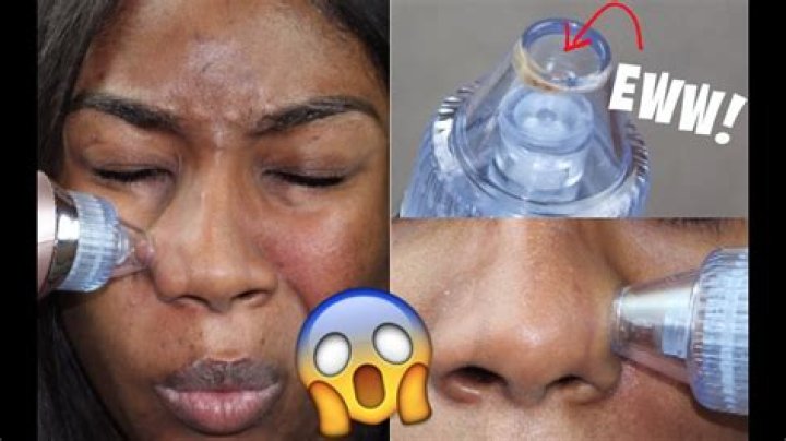 Do blackhead vacuums work?