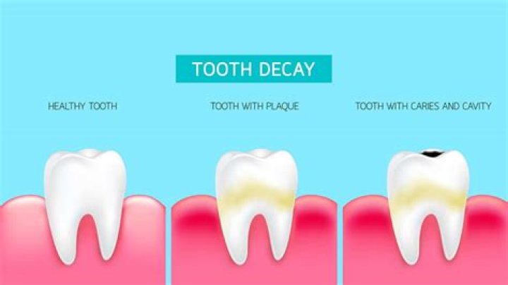 Do decaying teeth smell?