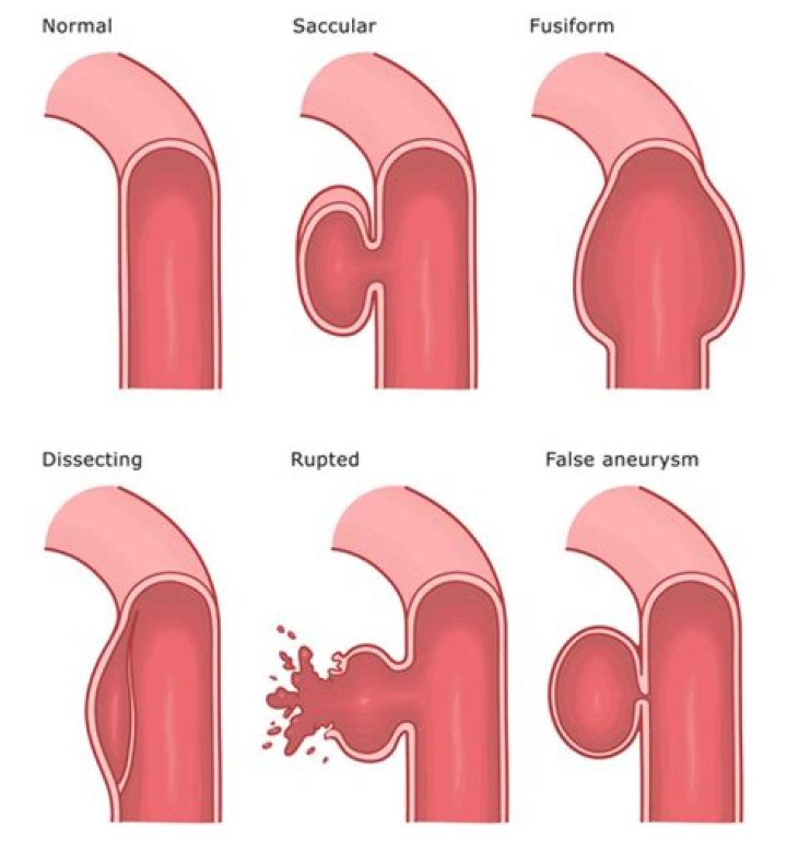Do fusiform aneurysms rupture?