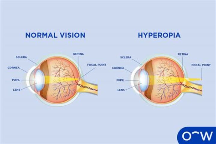 Do i have hyperopia?