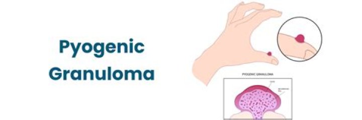 Do pyogenic granulomas grow back?
