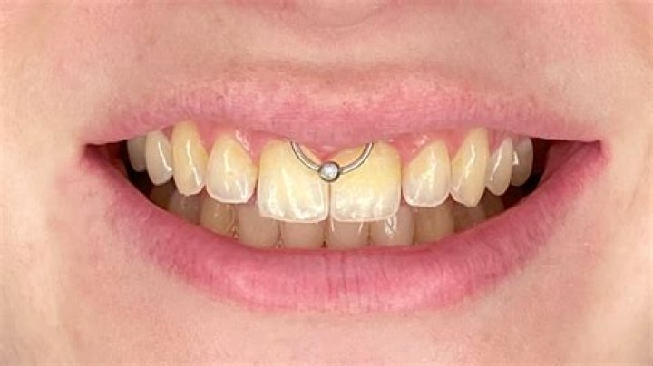 Do smiley piercings damage your teeth?