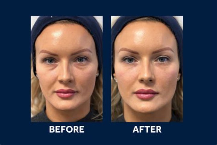 Do tear trough fillers work for dark circles?