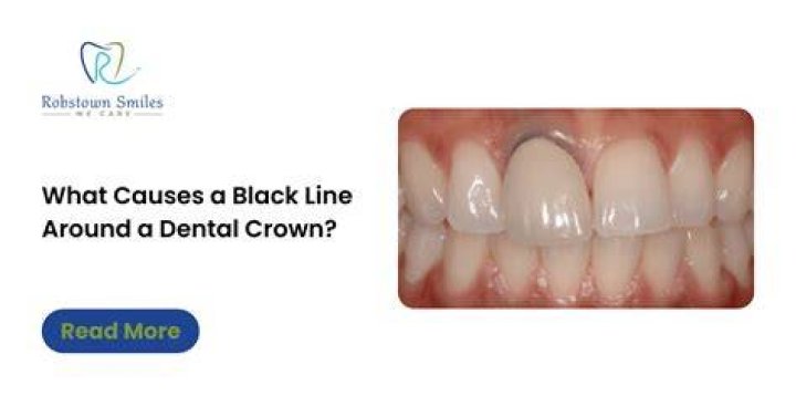 Do teeth turn black under a crown?