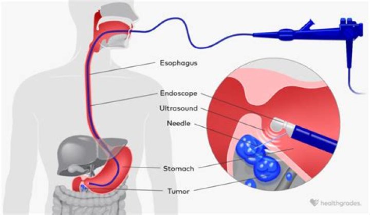 Do you have to undress for an endoscopy?