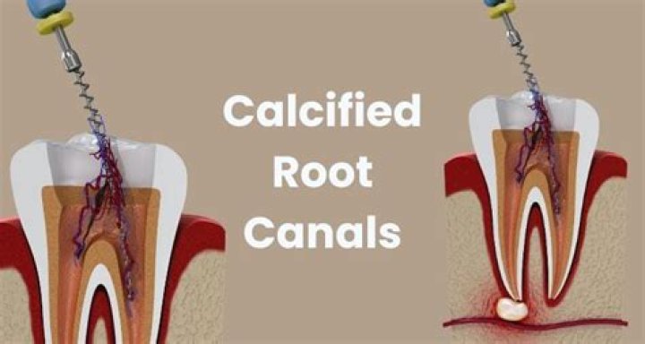 Does a calcified tooth need a root canal?