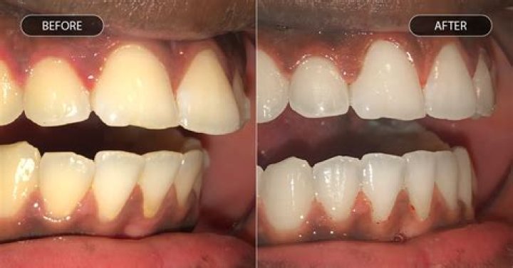 Does a clear aligners hurt?