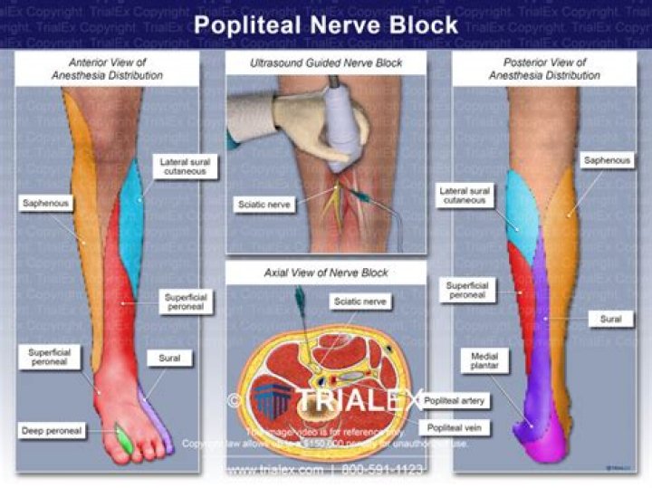 Does a popliteal nerve block hurt?