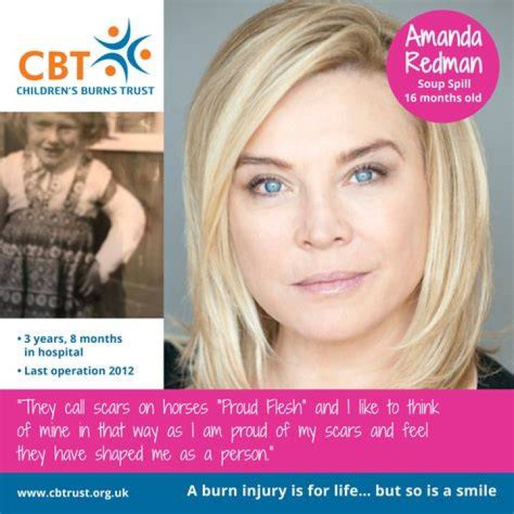 Does amanda redman have a scar on her arm?